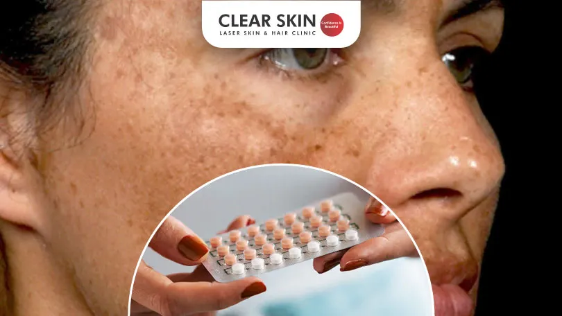 Understanding the Link Between Birth Control Pills and Melasma