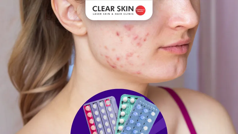 Does Birth Control Pills Cause Acne?