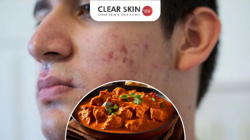 Does Eating Chicken Really Cause Acne?