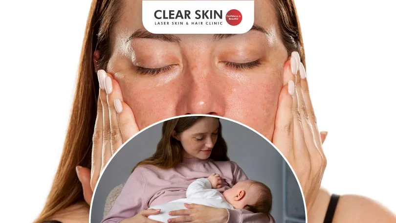 Understanding Melasma After Breastfeeding: Will It Disappear?