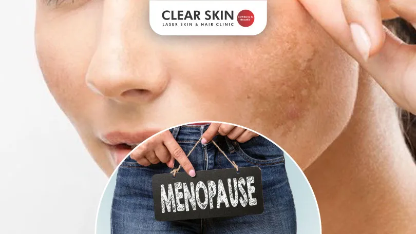 Understanding Melasma After Menopause: Will It Disappear or Persist?