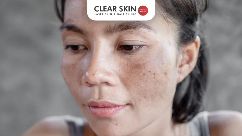 Does Melasma Go on its Own Clear Skin Pune