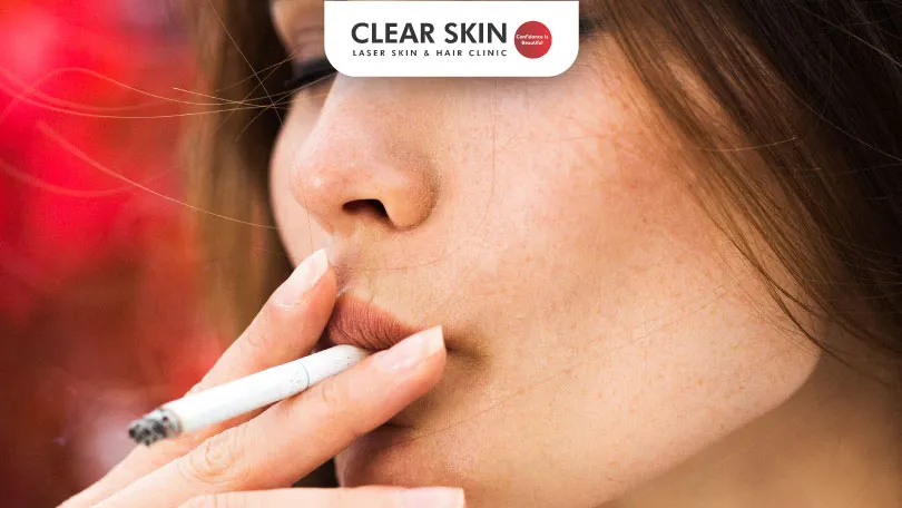 Does Smoking Cause Melasma?