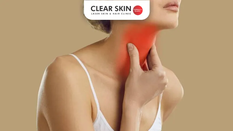 Does Hypothyroidism Cause Dry Skin?