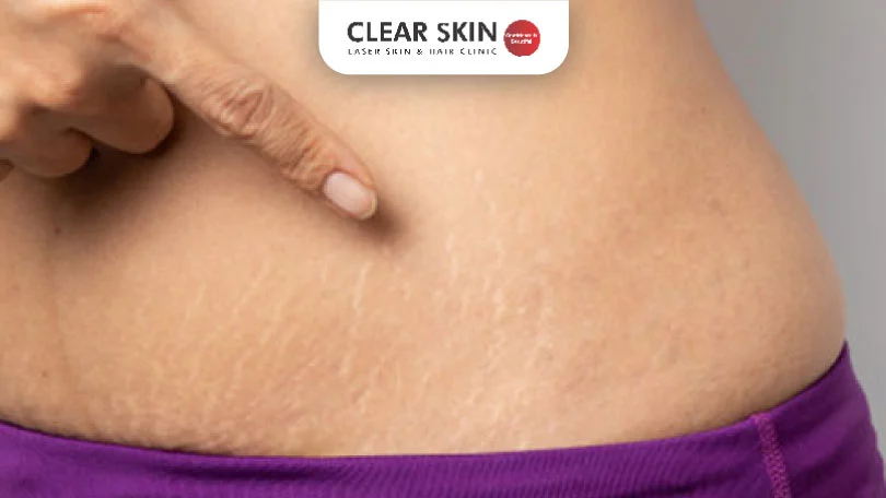 Effective Ways to Permanently Remove Stretch Marks