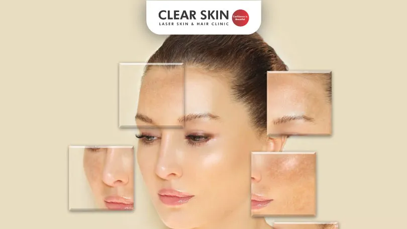 Erasing the Signs of Melasma How Laser Treatment Can Improve Your Symptoms Clear Skin Pune