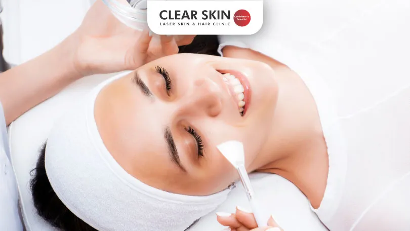 TCA Peel Treatment for Melasma | Clear Skin Clinic