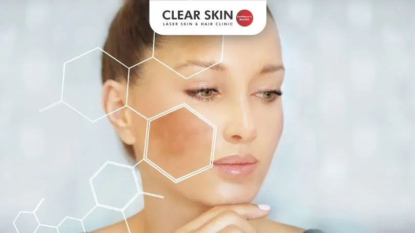 Expert-Tips-for-What-Can-You-Do-for-Melasma-clear-skin-pune