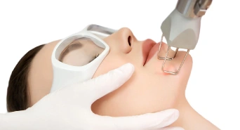 Fractional CO2 Laser