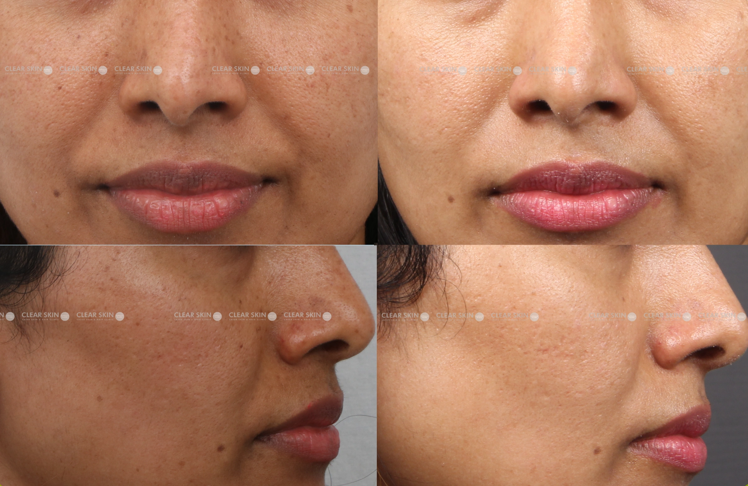 Freckles Results 4 Months Timeline 3 Sessions ClearSkin Pune