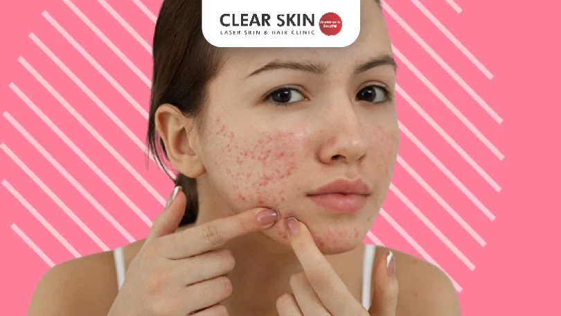 Home Remedies for Acne Scars clear skin pune