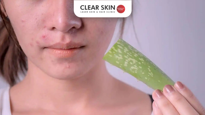 How Aloe Vera Combats Acne and Reveals Radiant Skin?