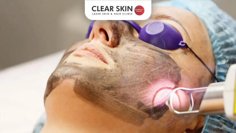 How Carbon Laser Facial Reduces Melasma Pigmentation