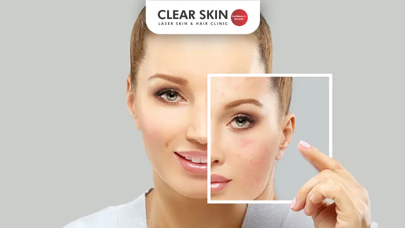 How-Long-Does-it-Take-for-Melasma-to-Go-Away-Clear-Skin-Pune