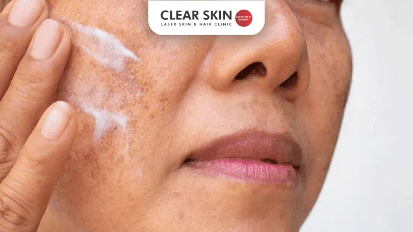 How Moisturisers Can Help with Melasma Prevention and Treatment?