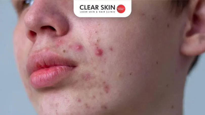 Effective Strategies to Clear Teenage Acne