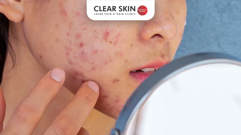 How To Take Care Of Acne Prone Skin Clear Skin Pune