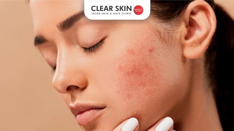 How long did it take for Your Acne Scars to Fade?