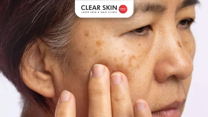 How long does it take for Melasma to Fade?