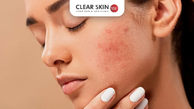 Home Remedies for Acne Treatment