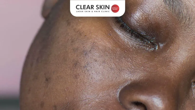 How to Manage Melasma in Dark Skin