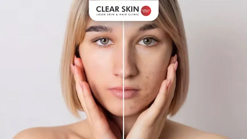 How to Remove Pigmentation from Face?