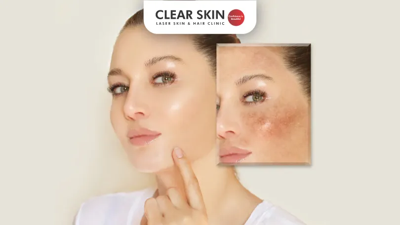 How to Treat Melasma Effectively with Topical Medications?