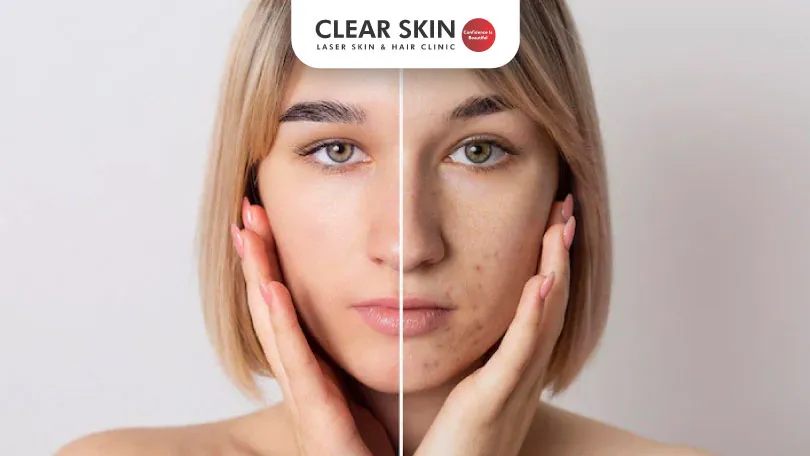 How to Treat an Uneven Skin Tone Clear Skin Pune