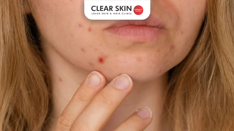 How to get Rid of Acne Dark Spots?