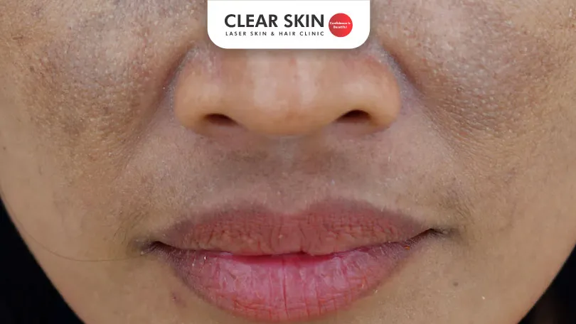 How to get Rid of Pigmentation around Lips?