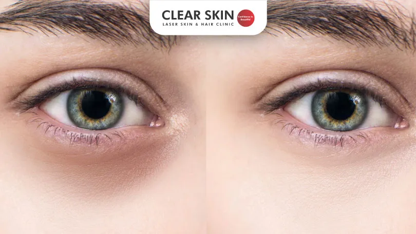 How to reduce Dark Circles: Causes, Treatment: Clear Skin