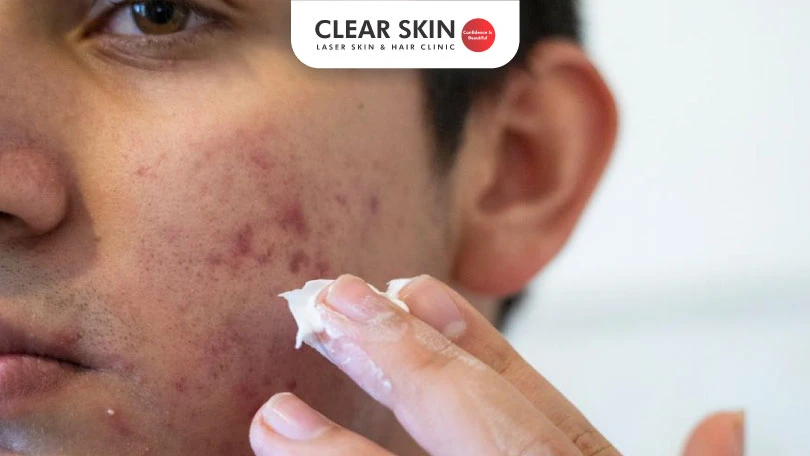 How to Remove Acne Marks?