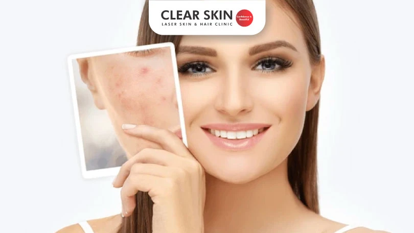 How to Remove Acne Scars?