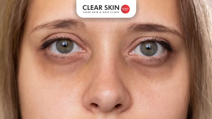 How to Remove Dark Circles Under your Eyes Permanently?