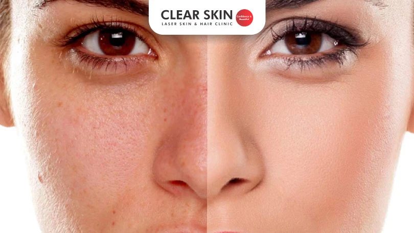 how to treat skin pigmentation