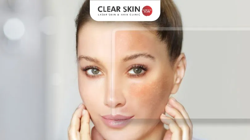 Identifying Melasma on Your Skin