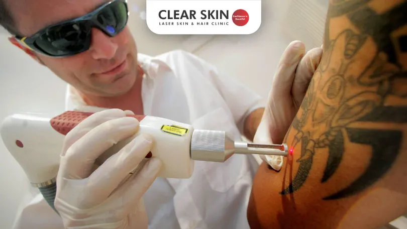 Is Tattoo Removal Painful?