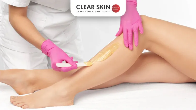 Is Waxing Safe After Laser Hair Removal?