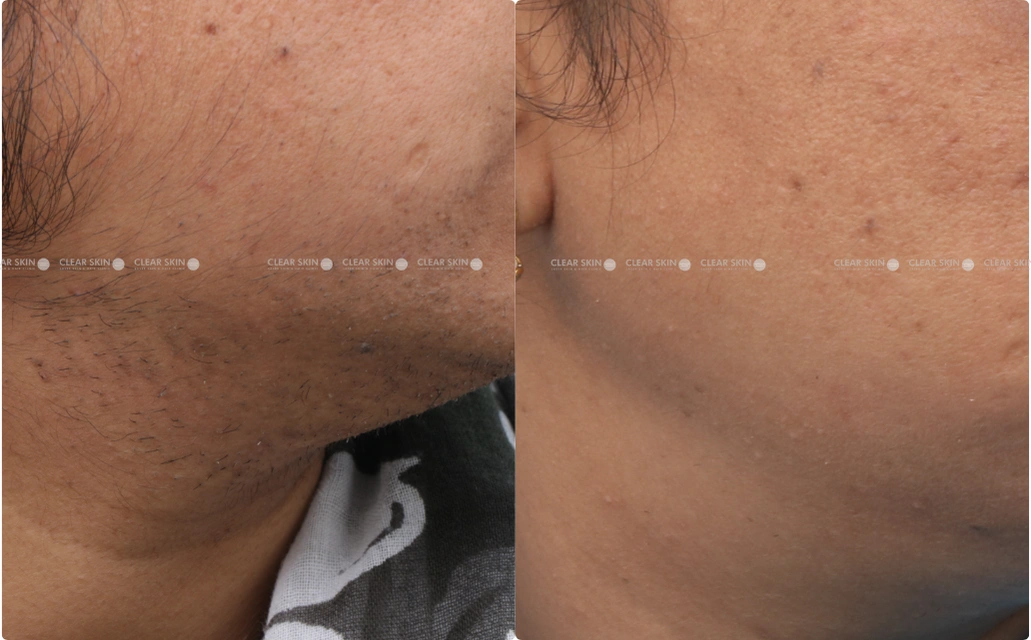 LHR Results 3 Sessions 3 Months ClearSkin Pune