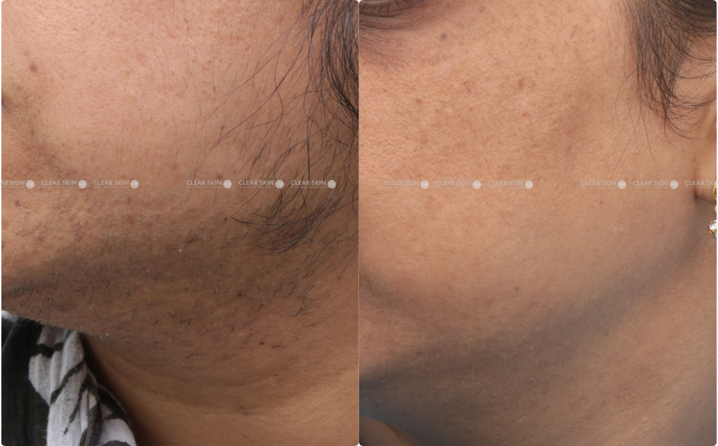 LHR Results 3 Sessions 3 Months ClearSkin Pune