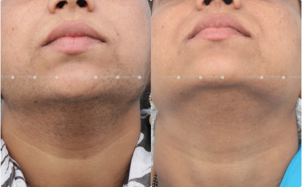 LHR Results 3 Sessions 3 Months ClearSkin Pune