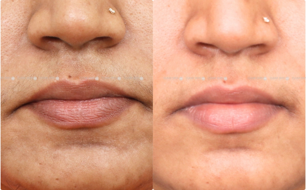 LHR Results 5 Sessions 6 Months ClearSkin Pune