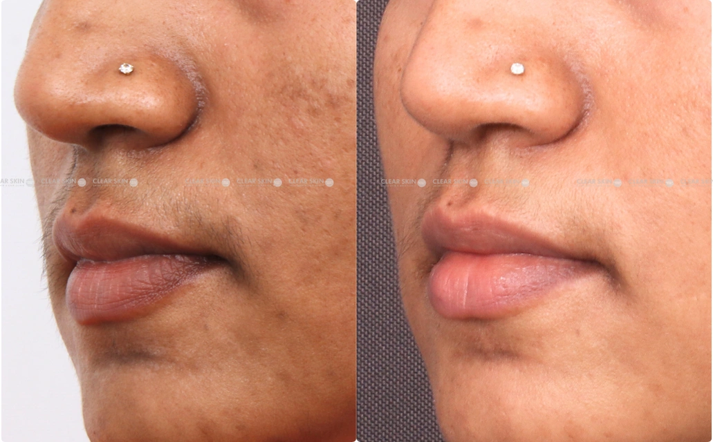 LHR Results 5 Sessions 6 Months ClearSkin Pune