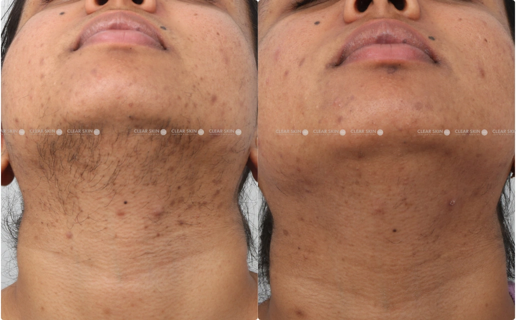 LHR Results 9 Sessions 9 Months ClearSkin Pune