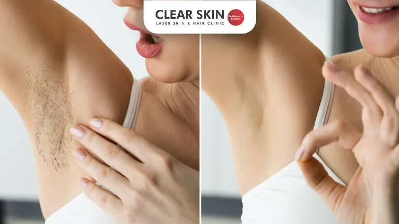 Laser-Hair-Removal-Before and After Results- Things to Know Clear Skin Pune