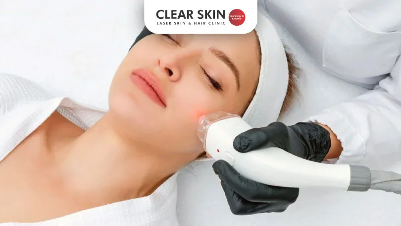 Laser Hair Removal for Sensitive Skin