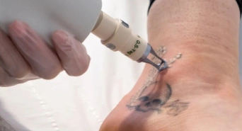 Laser Tattoo Removal