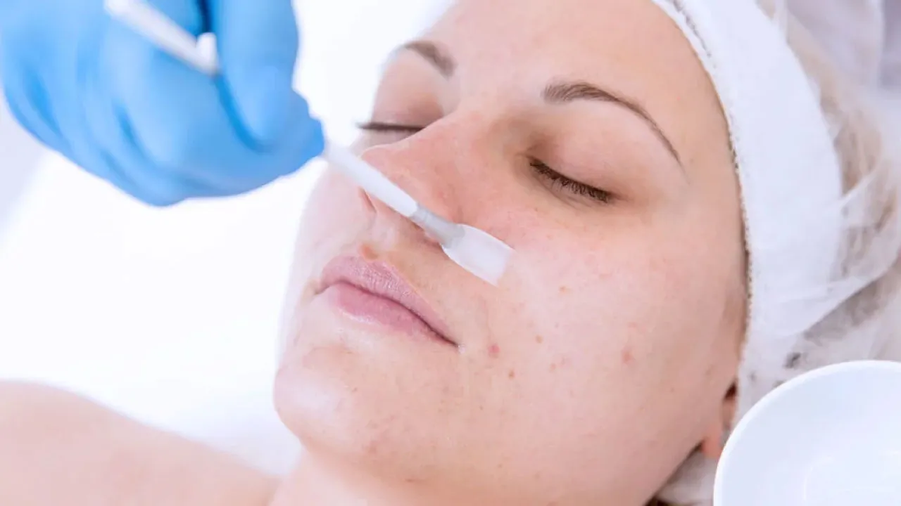 Leave On Chemical Peel Treatment