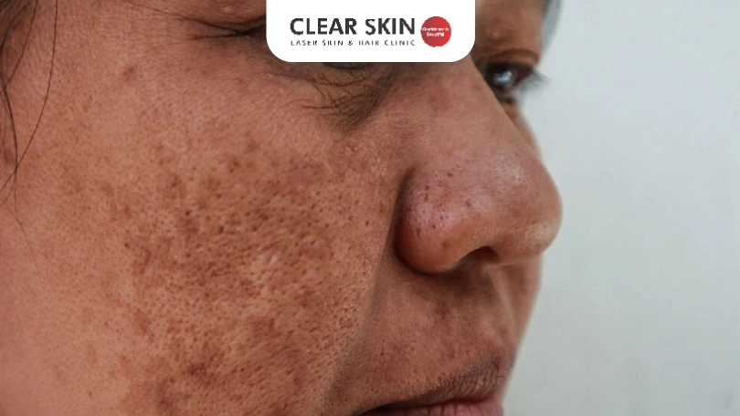 Melasma: Complete Guide to Causes, Symptoms, and Treatments