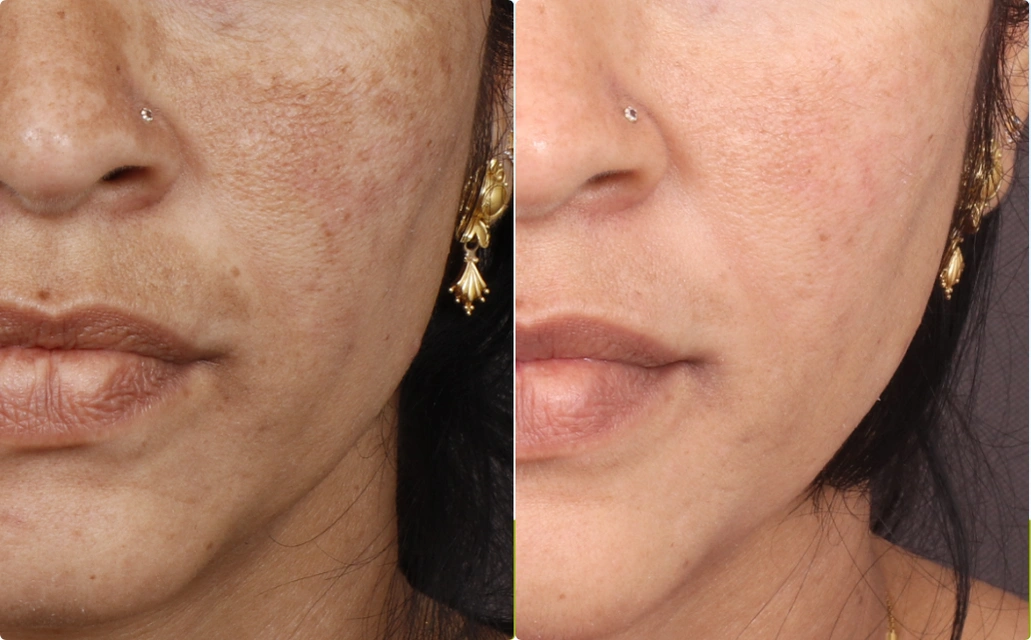 Melasma Results 2 Sessions 2 Months ClearSkin Pune